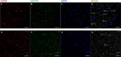 Prognostic stratification based on the levels of tumor-infiltrating myeloid-derived suppressor cells and PD-1/PD-L1 axis in locally advanced rectal cancer